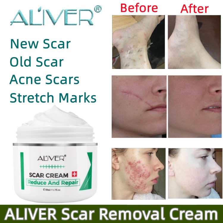 ALIVER Scar Repair Cream Remove Acne Scar remover Stretch Mark Scald