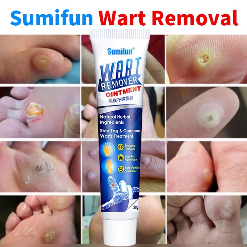 Warts Remover Cream Wart Removal Ointment Wart Treatment Skin Tags