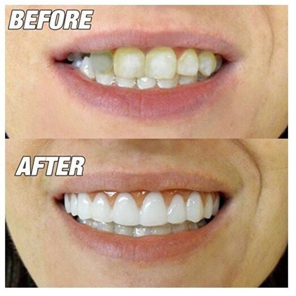 Press On Veneers Philippines is rated the best in 03/2022 BeeCost