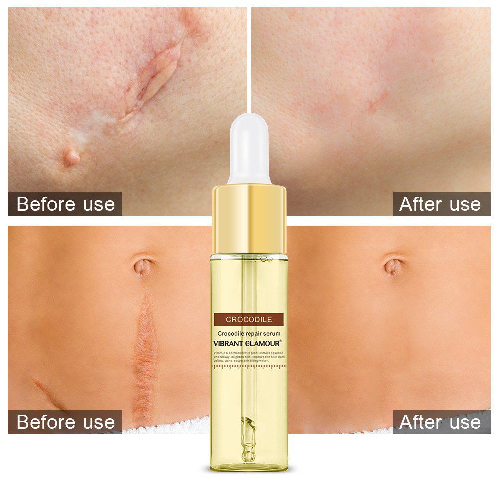 VIBRANT GLAMOUR Acne Scar Removal Serum Skin Repair Scar Essence Acne