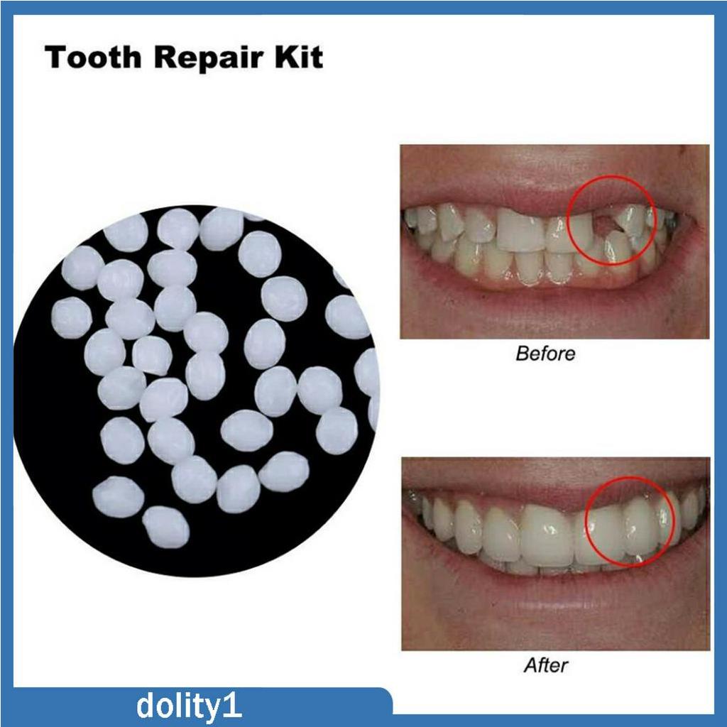 [DOLITY1] Dental Thermal Beads Teeth Veneers Moldable Denture Temporary Tooth Repair Shopee