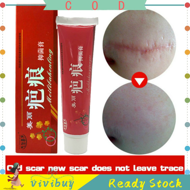 Herbal Chinese Medicine Remove Scar Cream Scar Gel Acne Scar Removal