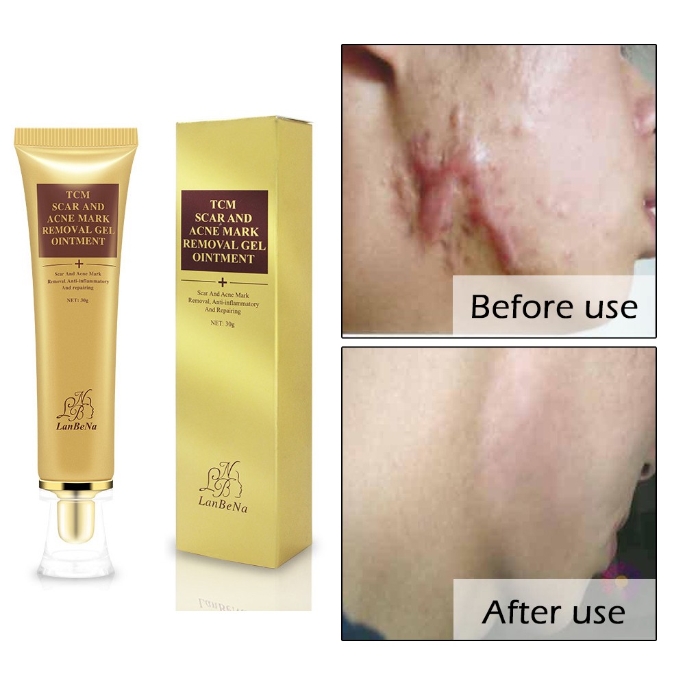 Acne Scar Mark Removal Cream Antiinflammatory Repairing Gel Skin Care