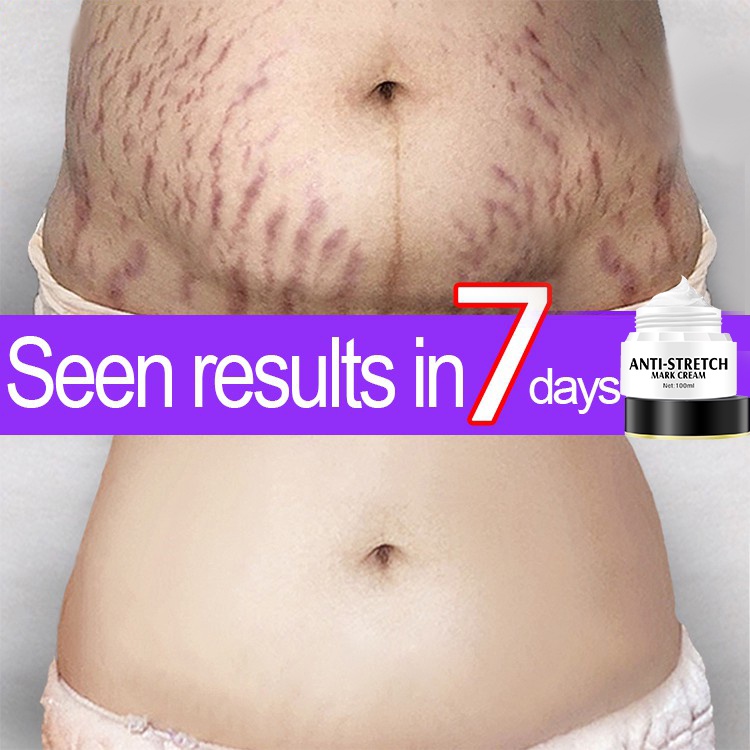Scar Removal Cream Stretch Mark Repair Cream removal fat streaks