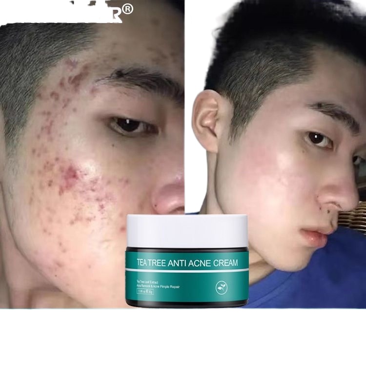 SKIN EVER AntiAcne Pimple cream quickly effectively remove acne fade