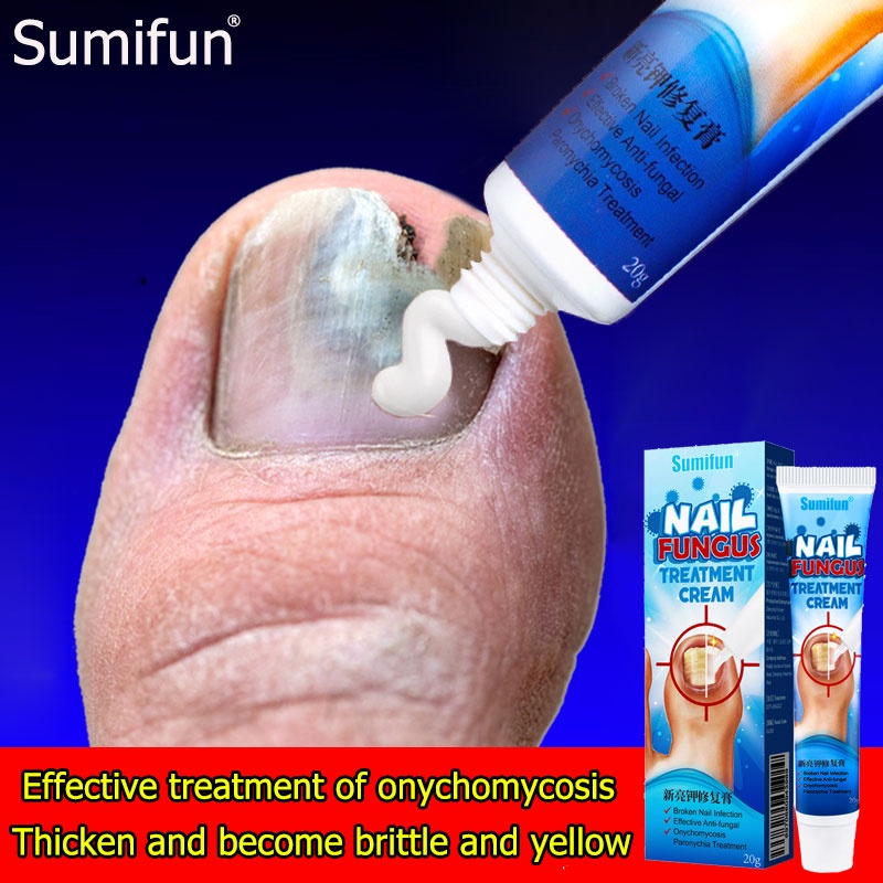 Antibacterial Cream Anti Fungal Cream Nail Fungus Treatment Paronychia