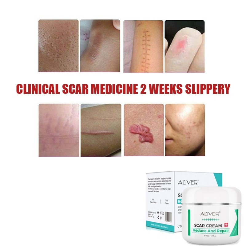 Scar Removal Cream For Old Scars, Stretch marks Scar Gel Treatment