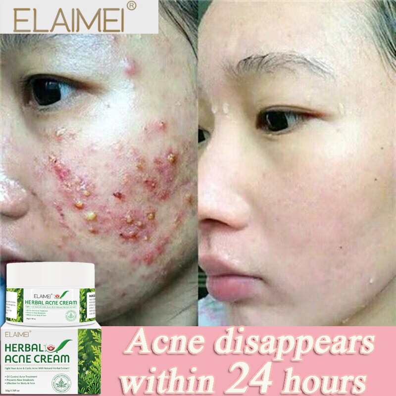 Elaimei Acne Scar Removal Cream Skin Repair Face Cream Acne Treatment