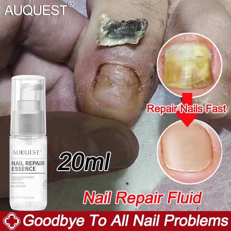 AuQuest Fungal Nail Treatment kill nail fungus Nail Care Nail Fungus