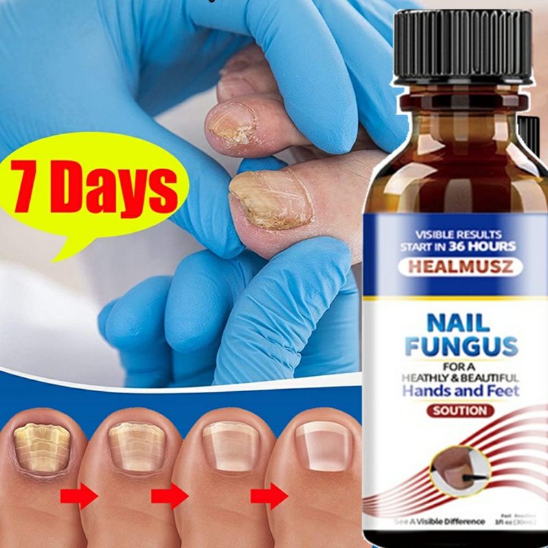 healmusz nail fungus removal onychomycosis hands and feet nail care