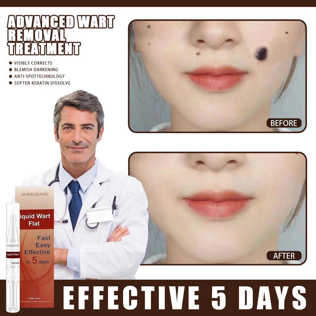 Genital Wart Treatment Papillomas Removal of Warts Liquid From Skin