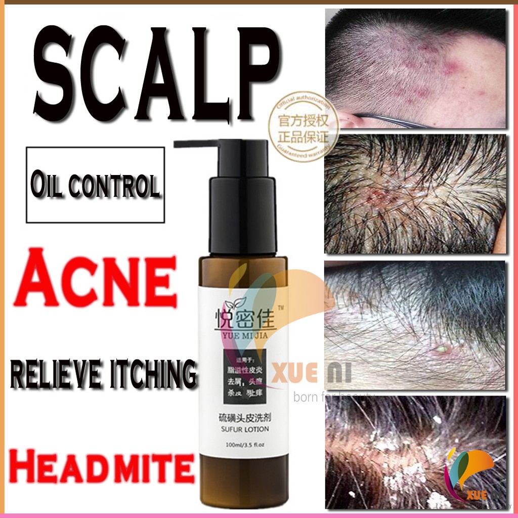 Scalp folliculitis red and swollen acne antidandruff and antiitchy mite shampoo RR77 Shopee