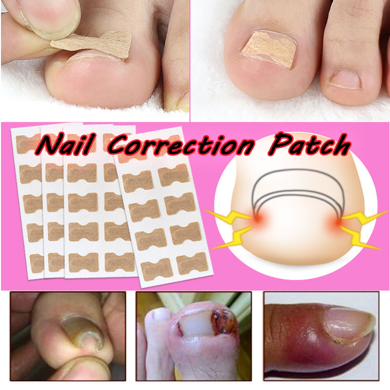 10pcs Correction Patch Ingrown Toenail Bandage To Relieve Pain and
