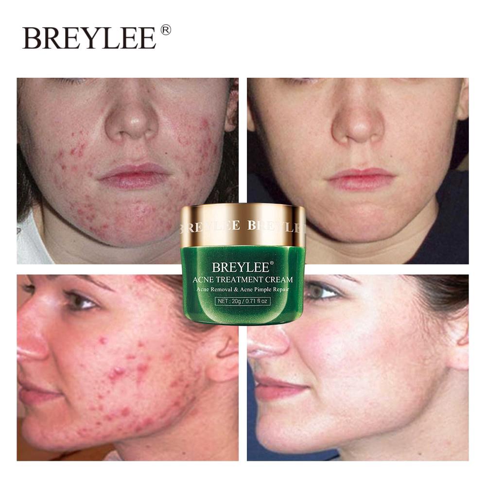 BREYLEE Acne Treatment Cream Anti Acne Face Cream Shopee Singapore