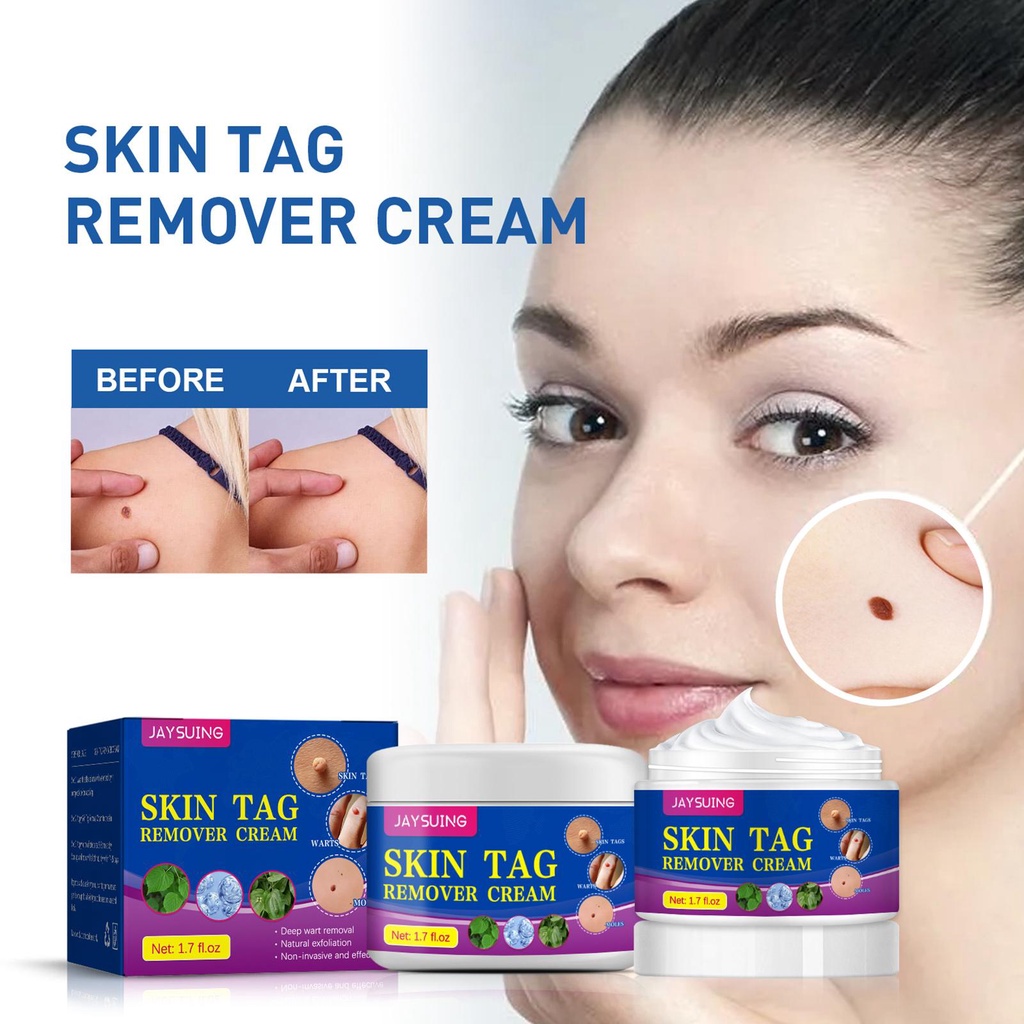 Mole Tag Wart Remover Ointment Antibacterial Solution Remove Fleshy