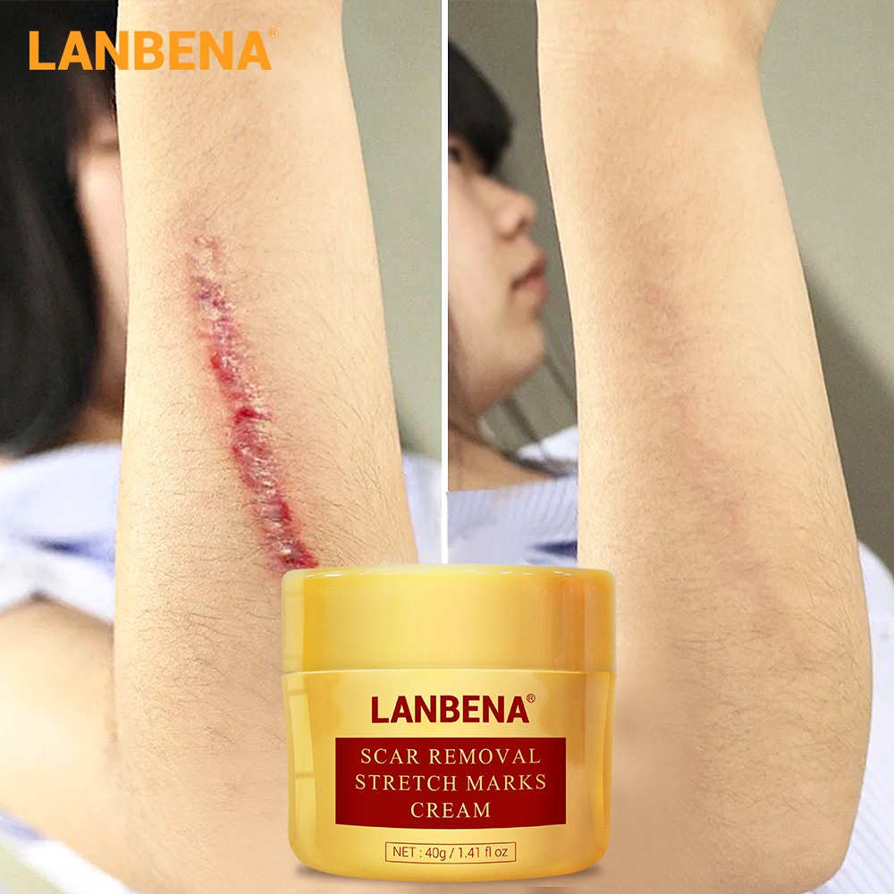 LANBENA Scar Removal Cream Acne Treatment Repairing Scar Shopee Singapore