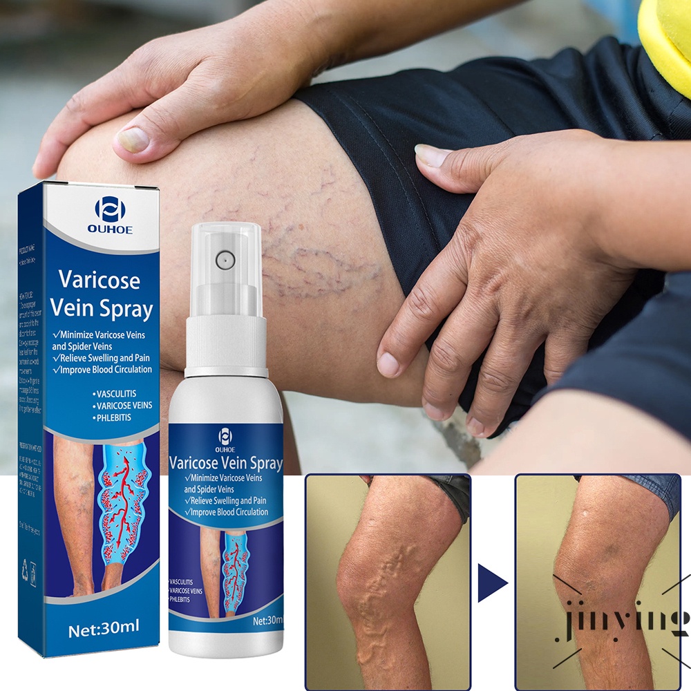30ml Varicose Vein Treatment Spray Relief Phlebitis Angiitis Nerve Pain