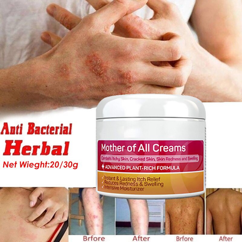 Mother Of All Skin Creams Psoriasis Cream Dermatitis Eczematoid Eczema Ointment Treatment