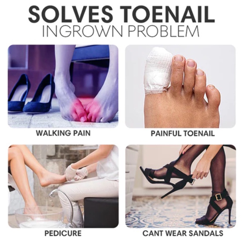 Ingrown Toenails Stickers Gluefree Toenail Patch Painless Pedicure