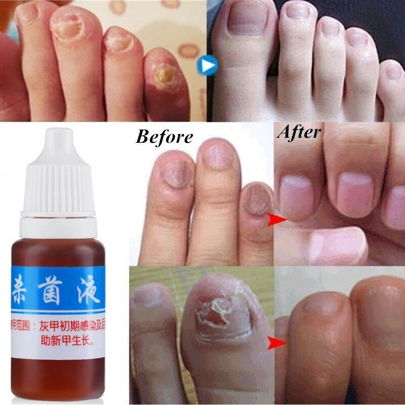 Nail Fungus Treatment 10ml Onychomycosis Paronychia Anti Fungal Herbal