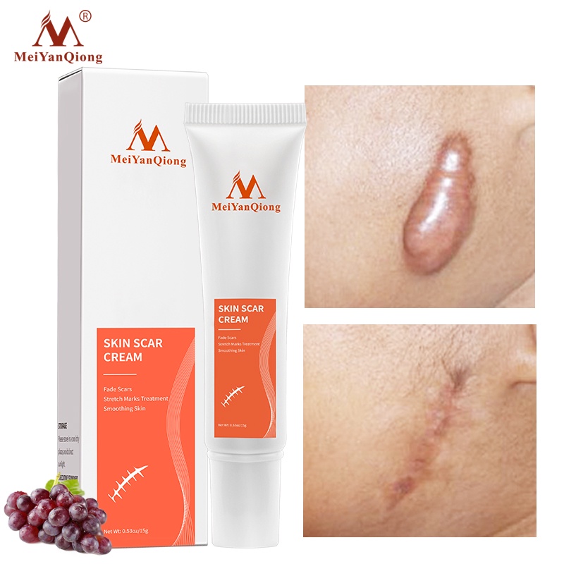 MeiYanQiong Acne Scar Removal Cream Skin Repair Stretch Marks giảm sẹo