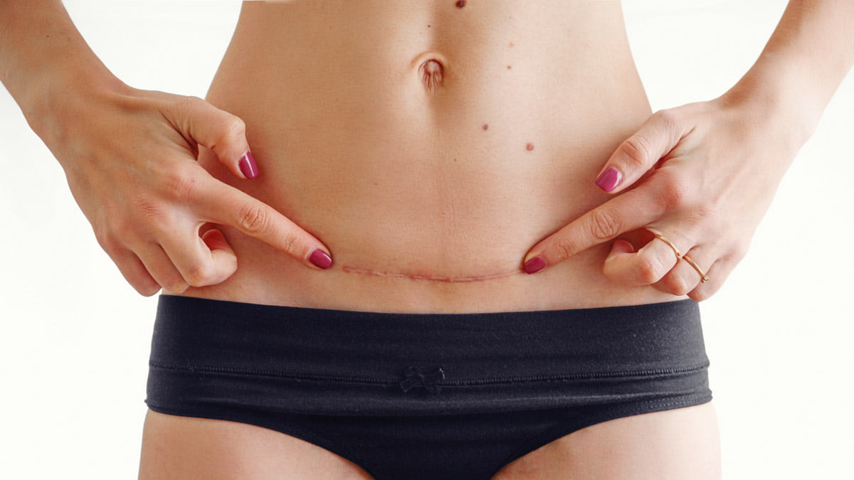Childbirth What You Need to Know About Cesarean Section CFAH