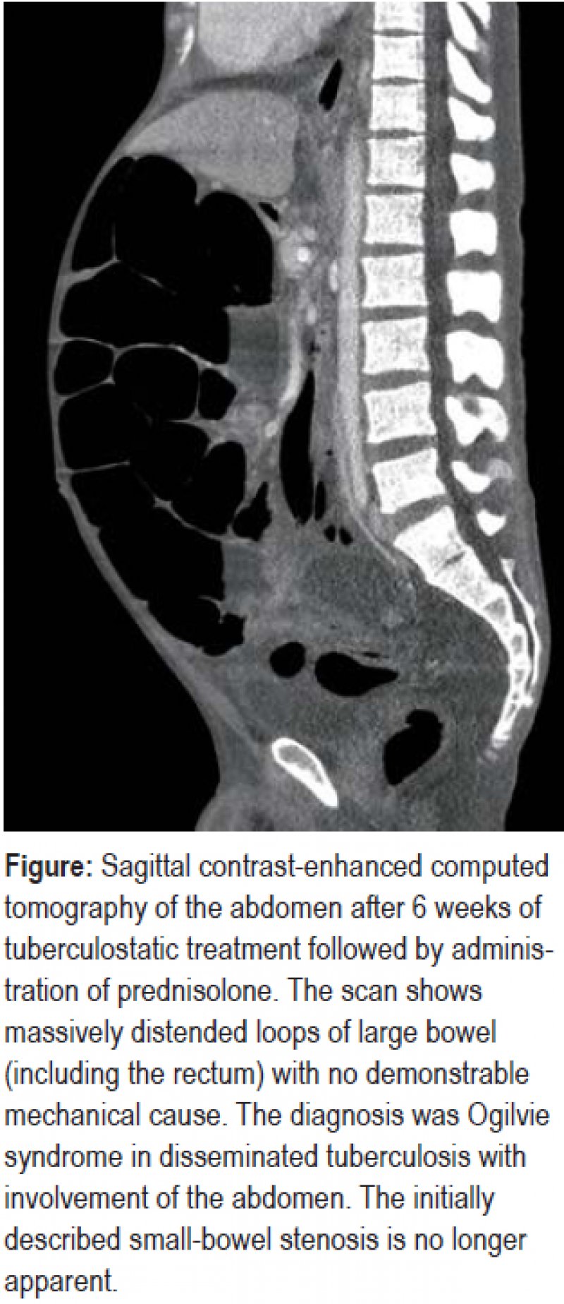 Ogilvie Syndrome in Disseminated Tuberculosis (01.03.2019)