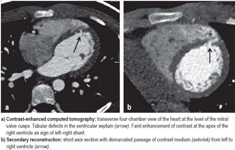 Swiss Cheese Defect of the Ventricular Septum (17.01.2020)
