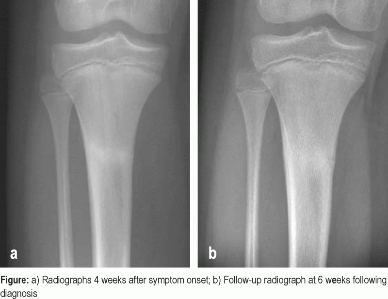 Stress Fracture X Ray Tibia