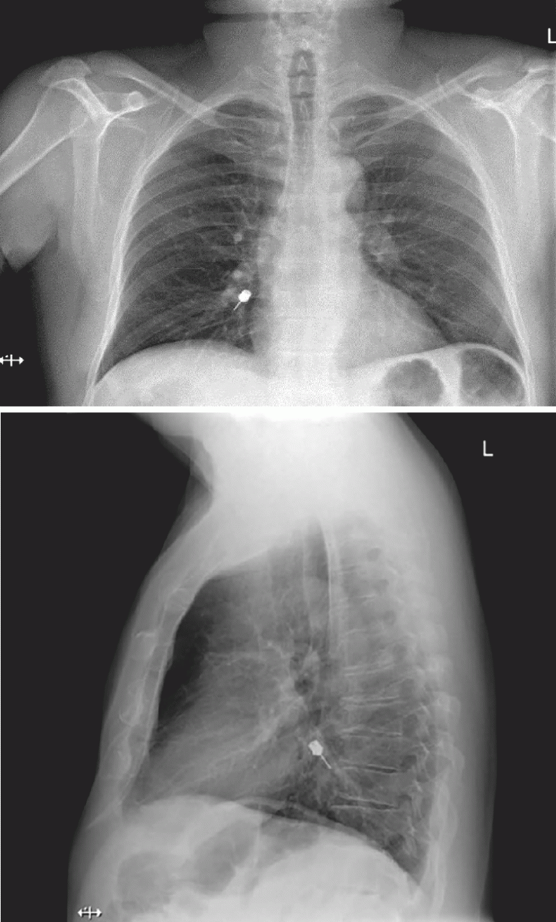Aspiration of an Instrument During Dental Treatment (04.06.2021)