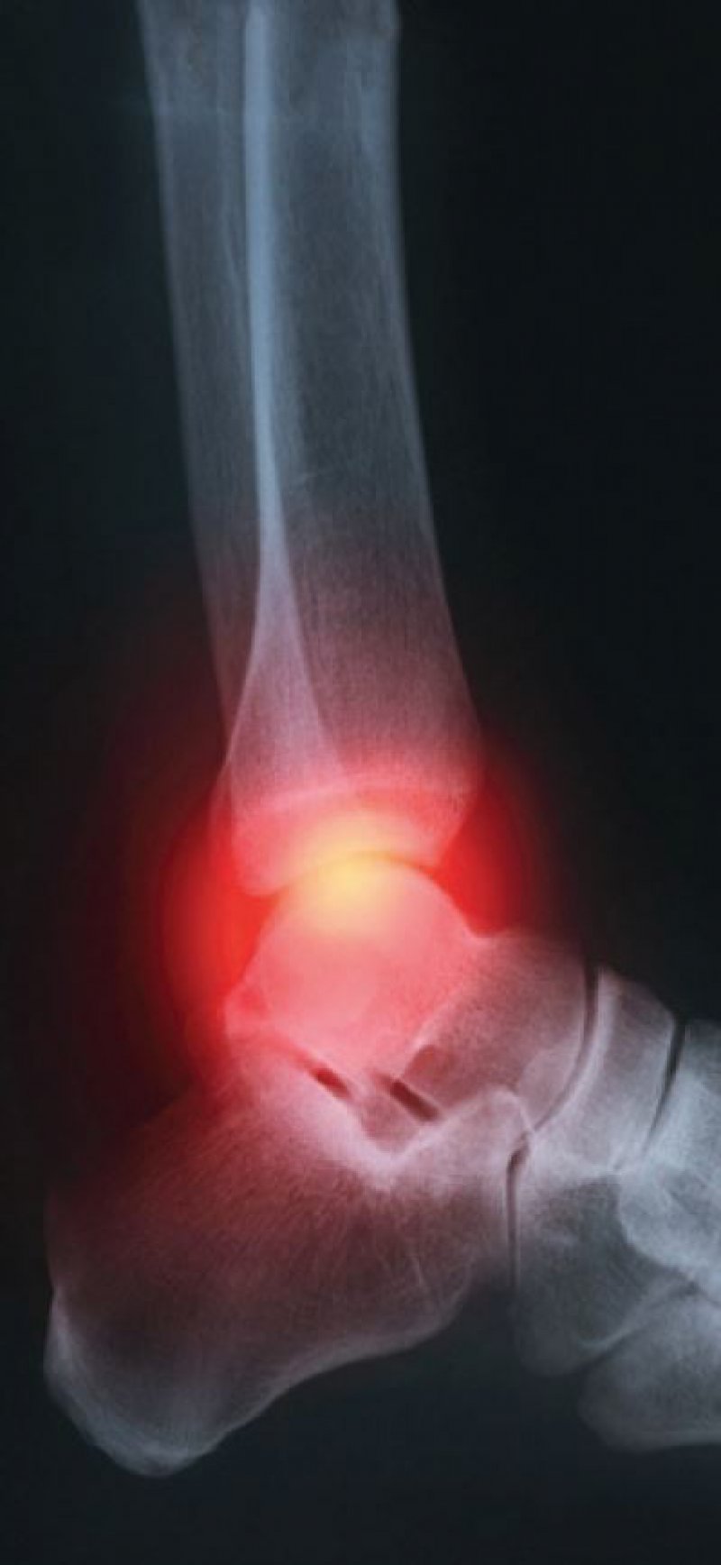 Arthritis urica Sterblichkeitsrisiko durch COVID19 ist bei Gicht