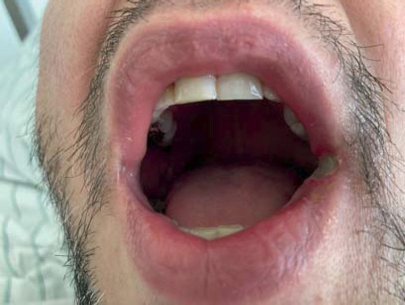 Ulcer at Corner of Mouth as First Sign of Infection With Monkeypox