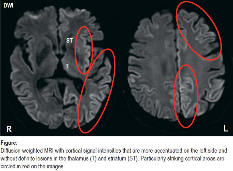 Cortical Signal Changes in CreutzfeldtJakob Disease (07.10.2022)
