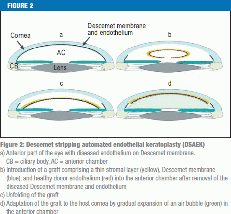 Descemet Stripping Endothelial Keratoplasty (24.05.2013)