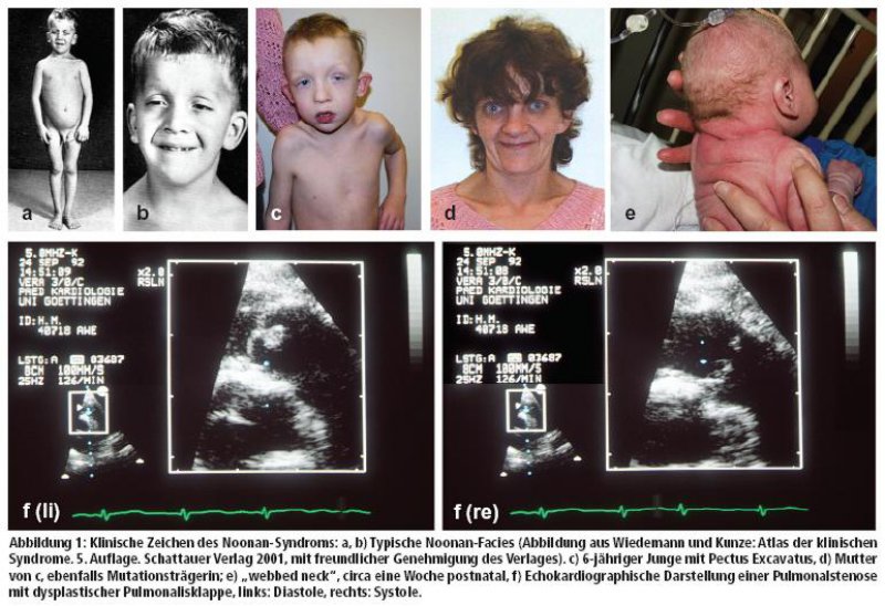 Das NoonanSyndrom