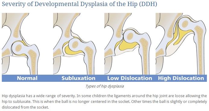 발달성 고관절 이형성증 Developmental Dysplasia of the Hip, DDH 건강행복