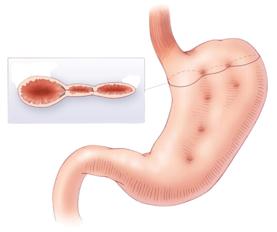 Endoscopic Bariatric Surgery A Safer Alternative for Effective Weight Loss