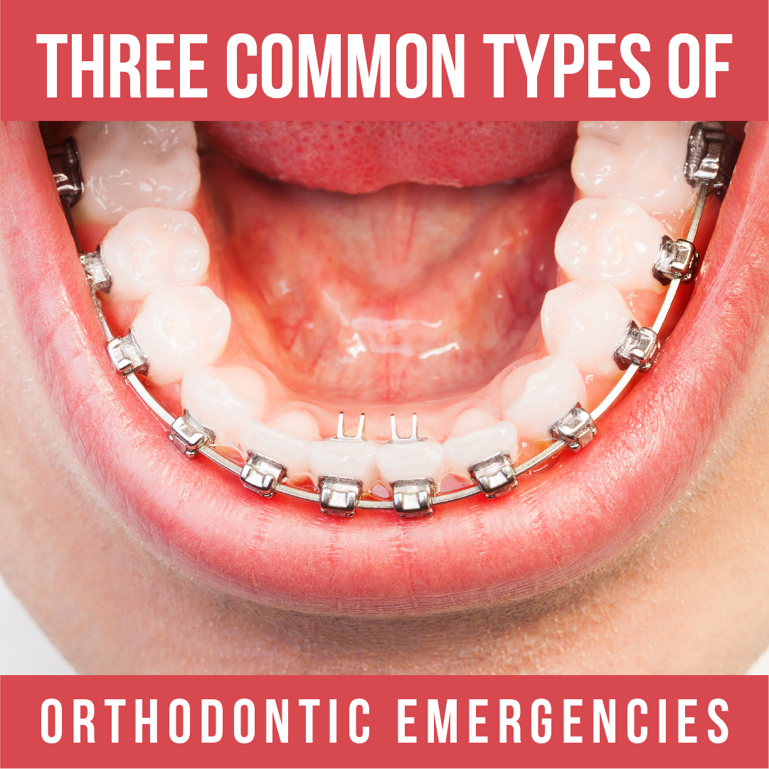 Orthodontic Emergencies Chamblee Orthodontics Atlanta, GA