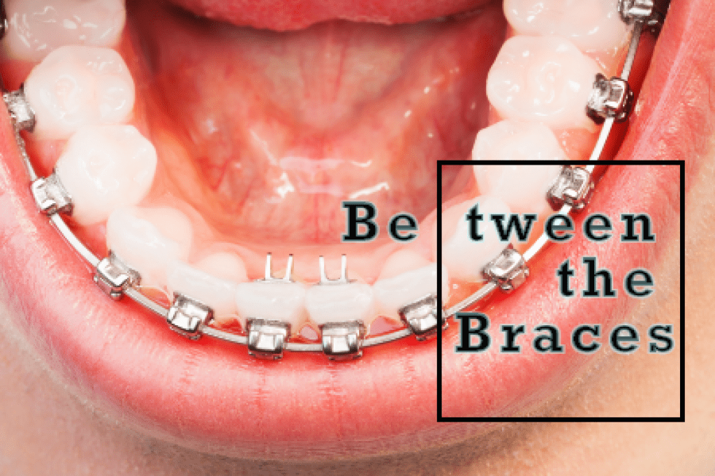 Oral Hygiene for Braces Chamblee Orthodontics Atlanta, GA