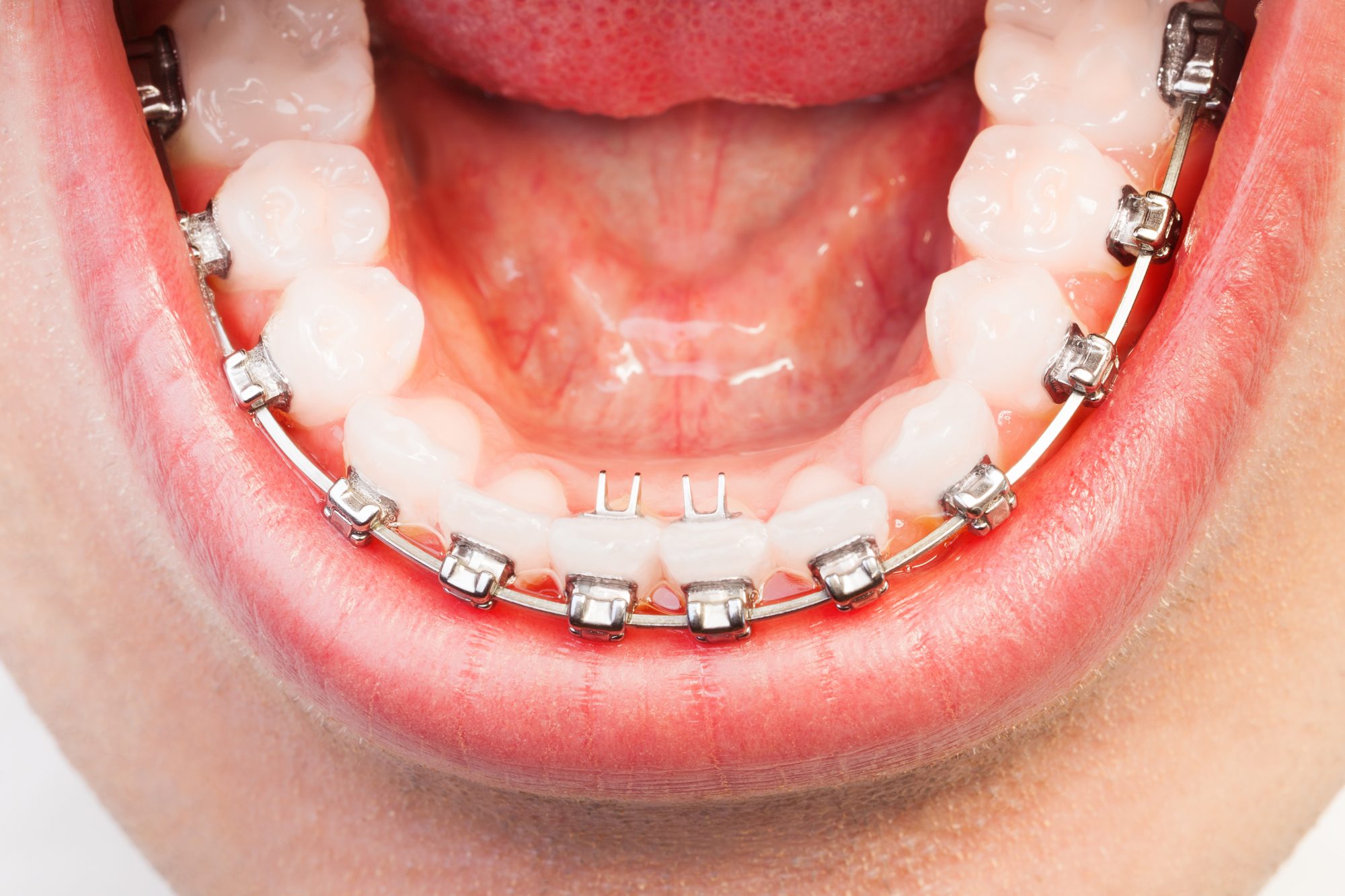 The Ideal Time for Orthodontic Treatment in Atlanta Dr. Caroline Ceneviz