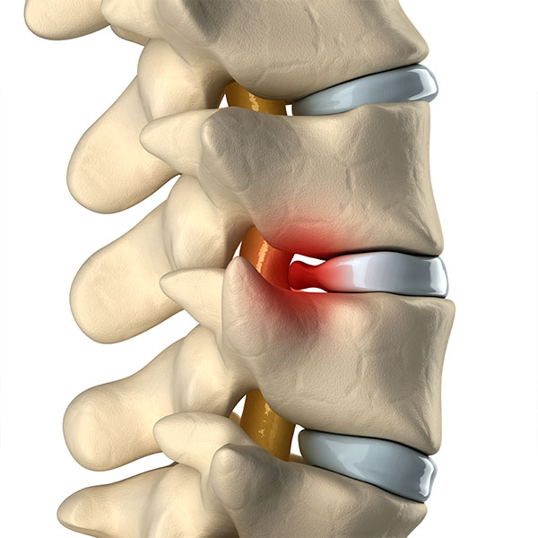 Herniated Disc Treatment NJ Champey Pain & Spine