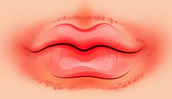 Đừng chủ quan, hãy nhớ những dấu hiệu của đôi môi cho thấy sức khỏe đang &#8216;kêu cứu&#8217; bạn doan benh qua doi moi cham do quanh moi