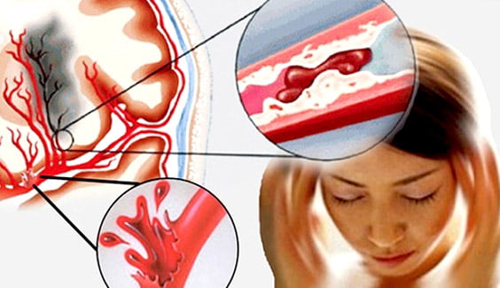du-phong-dot-quy du-phong-dot-quy du phong dot quy Dự phòng đột quỵ – Hãy thực hiện ngay từ bây giờ du phong dot quy