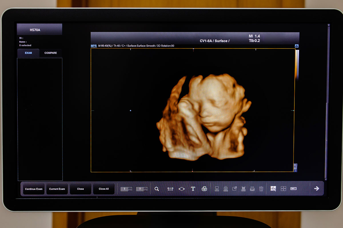 Exploring the Differences Between 3D and 4D Ultrasounds