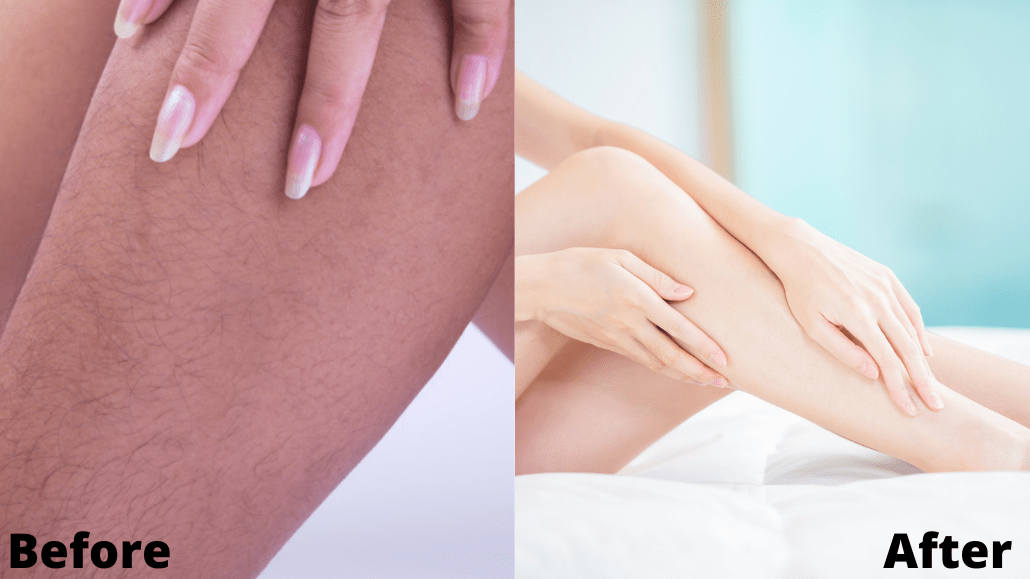 How Long Should Electrolysis Take? Charene Spa, Beauty, and Hair