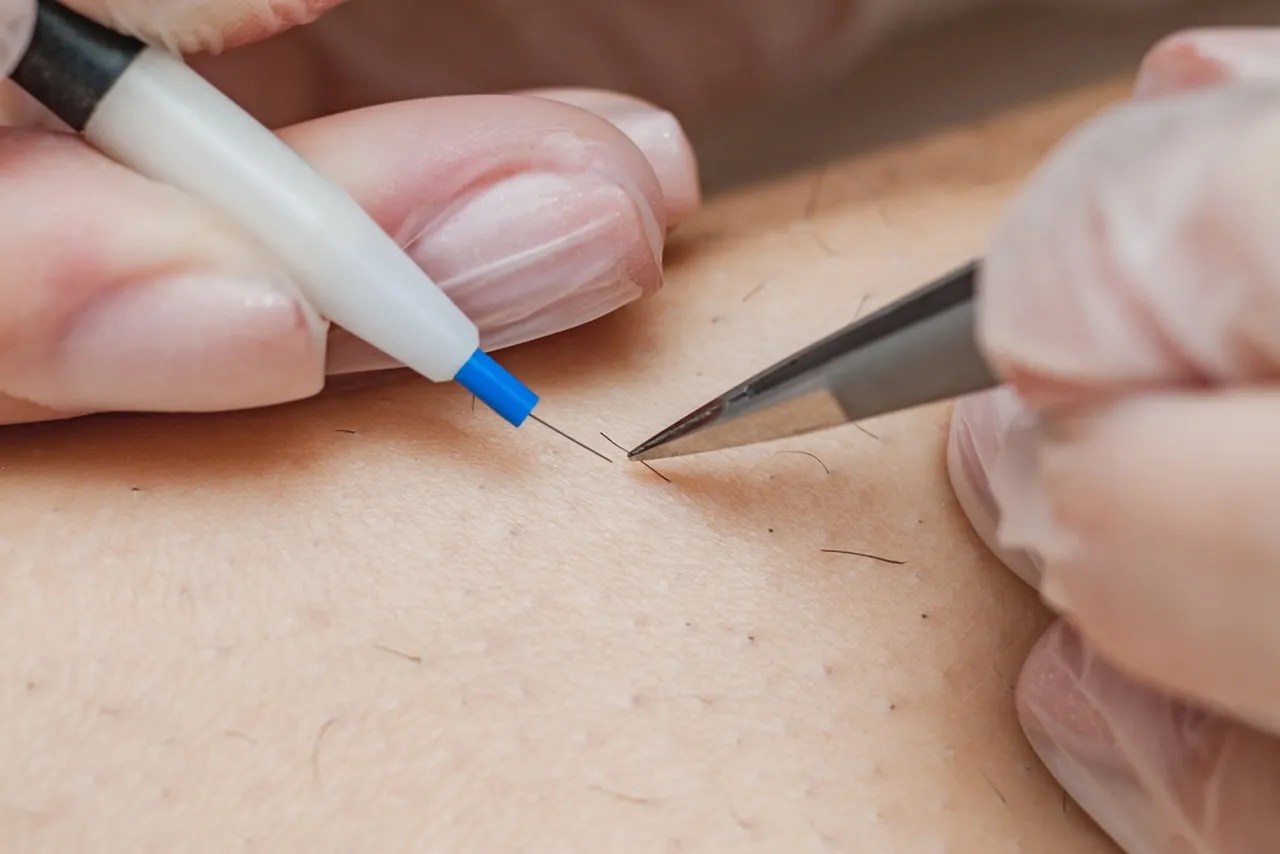Electrolysis Hair Removal A Comprehensive Guide