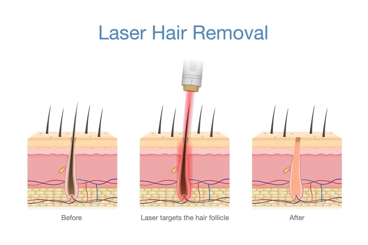 How Laser Hair Removal Works The Ultimate Guide To Smooth Skin