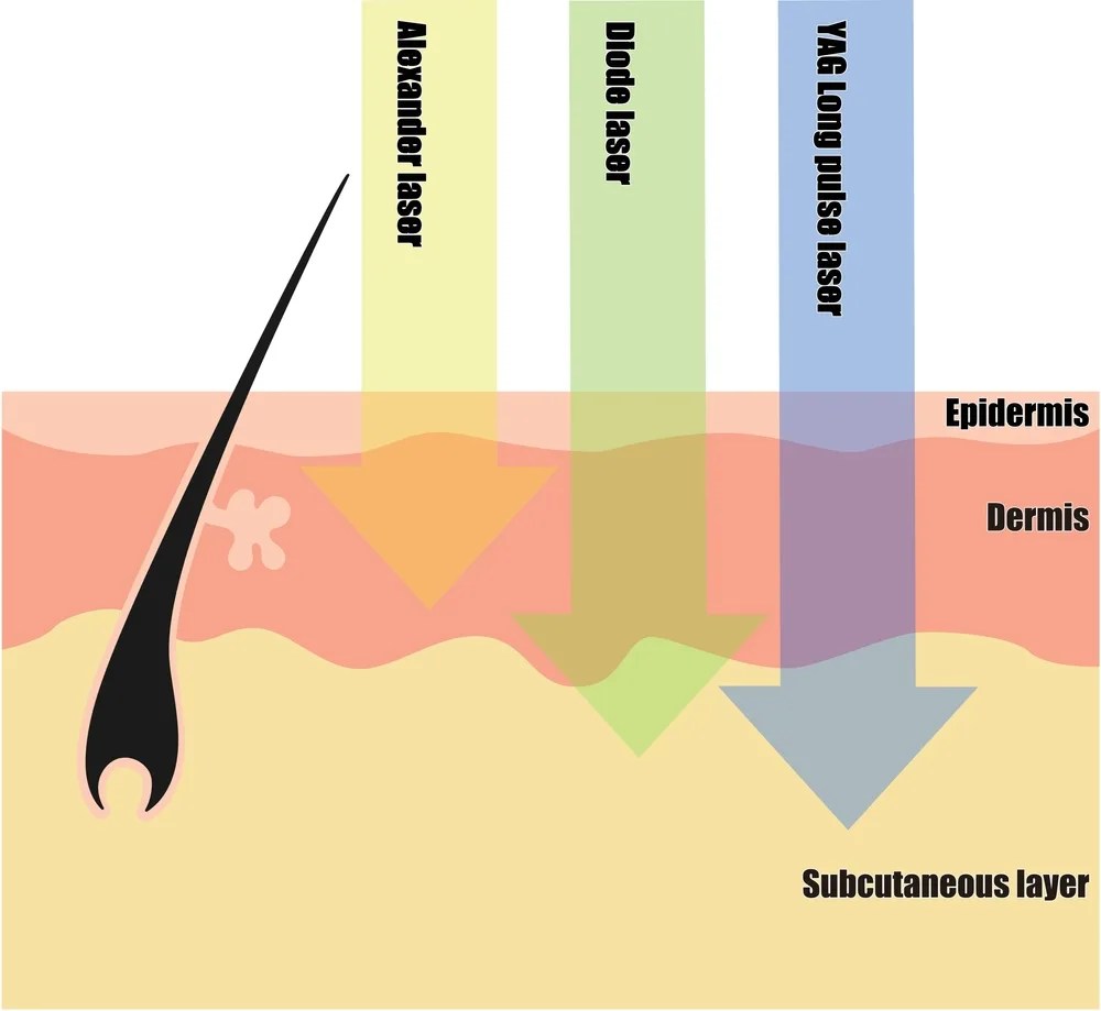 Can Gingers Get Laser Hair Removal?