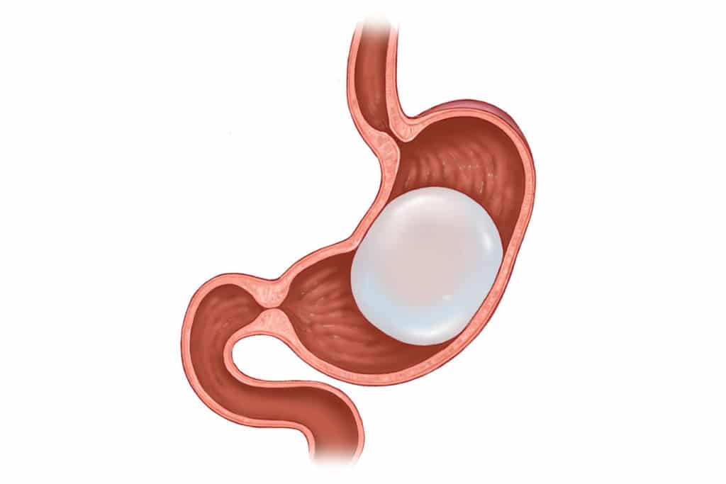 Intragastric Balloon (Malaysia) NonSurgical Method Cha Surgery