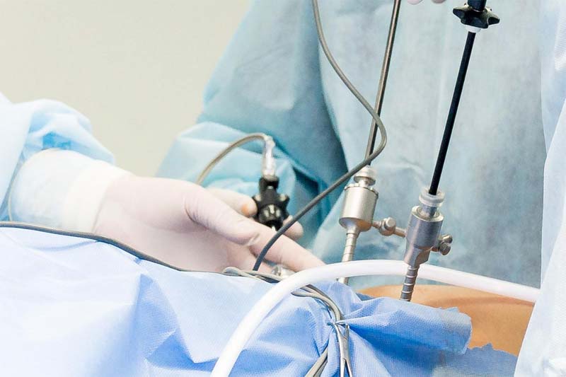 Acid Reflux Cha Surgery